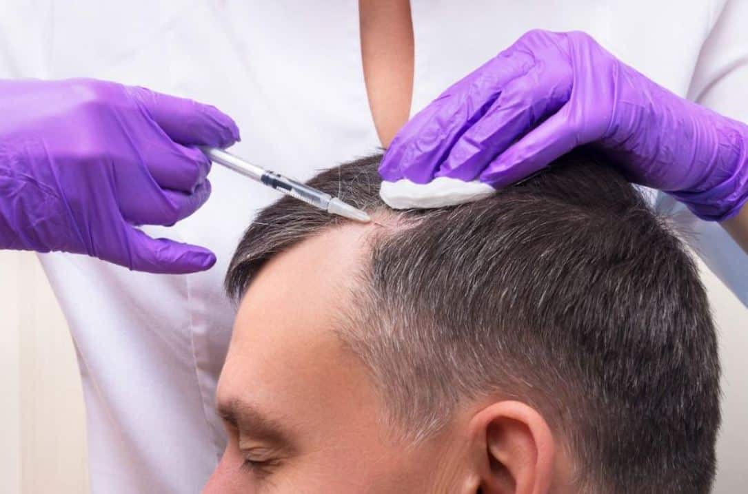 Hair Transplant UK Experts – Transforming Hairlines Every Day